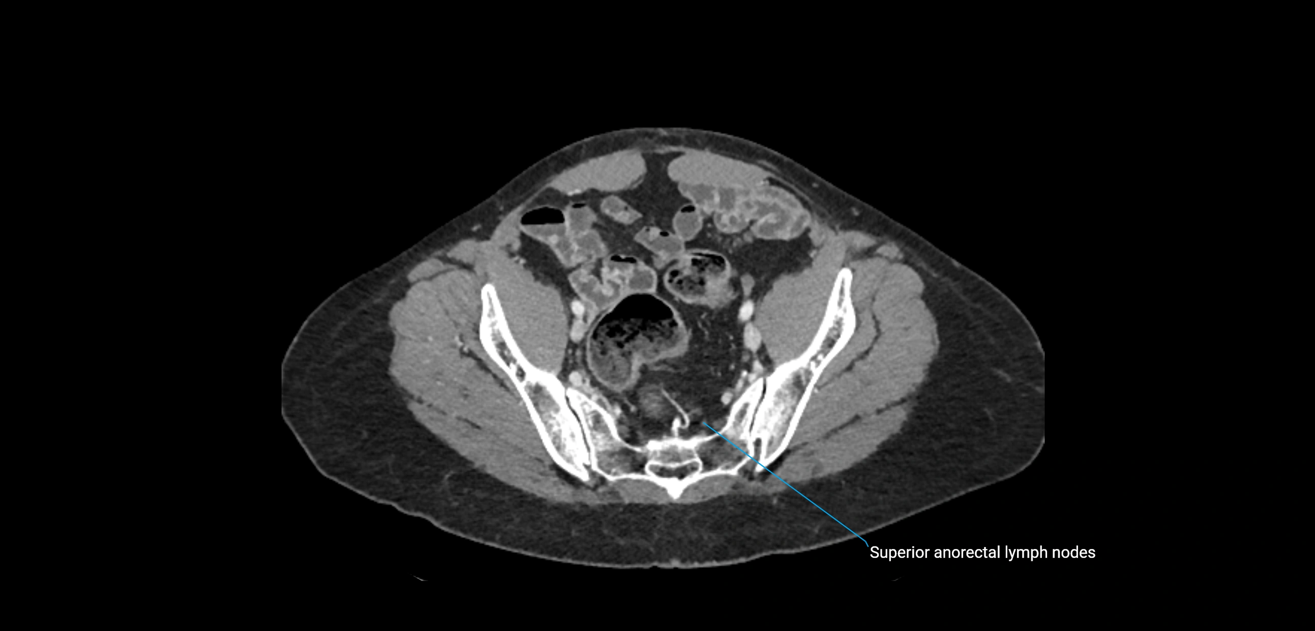 CT ct abdominal lymph nodes  axial cross sectional anatomy  enchanced radiology image -img-00002-00342.webp